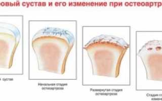 Здоровые суставы — профилактика и лечение