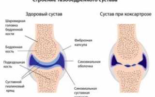 Здоровые суставы — профилактика и лечение