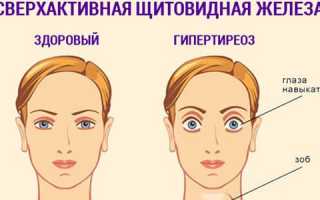 Гипертиреоз щитовидной железы