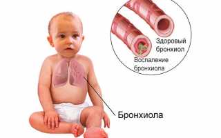 Как можно определить бронхит у взрослого и ребенка?