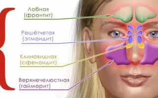 Воспаление пазух носа: лечение синуситов