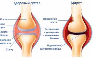 Осложнения после ОРВИ у детей: что делать если болят ноги после гриппа