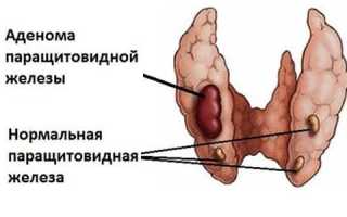 Симптомы и лечение аденомы паращитовидной железы
