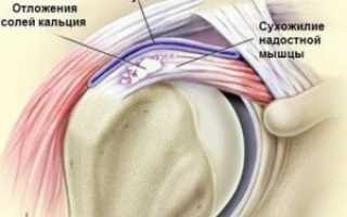 Здоровые суставы — профилактика и лечение