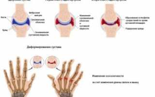 Здоровые суставы — профилактика и лечение