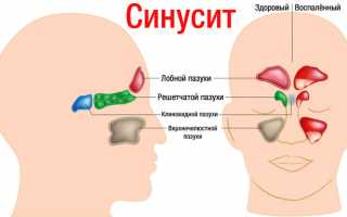 Коричневые сопли: выделения и слизь из носа у взрослого