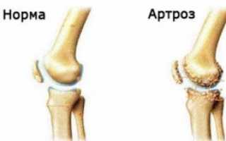 Здоровые суставы — профилактика и лечение