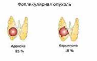 Как проводят биопсию щитовидной железы