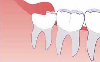 Отек после удаления зуба: причины, когда спадет, как убрать