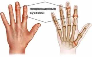 Здоровые суставы — профилактика и лечение