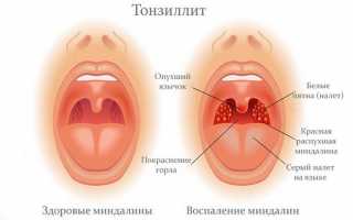 Болит миндалина с одной стороны: опухла гланда и глотать больно