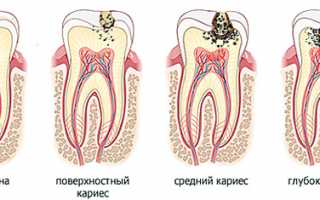 Лечение кариеса лазером, озоном и icon