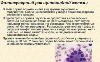 Фолликулярный рак щитовидной железы