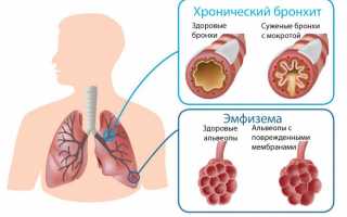 Хронический бронхит: симптомы, лечение, причины и осложнения