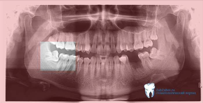 Болит зуб мудрости - почему ноет десна и как быстро снять боль