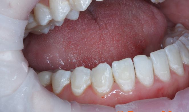 Причины и лечение черного налета на зубах у детей